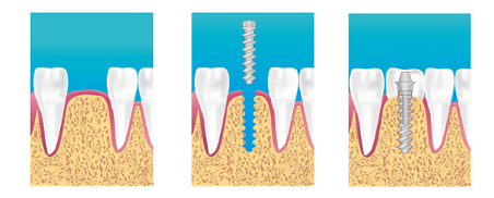 implant dentaire Paris 14